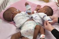 Conjoined Twins Successfully Separated in 13-Hour Surgery