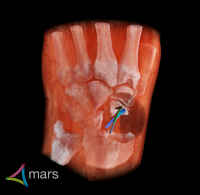 International trial of world-first 3D colour hand and wrist scanner announced - plus first patient images
