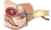 Expert urges action to tackle unsafe abortion in Nigeria