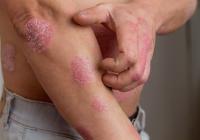 <![CDATA[Nonsteroidal Topicals Guide Special-Site Psoriasis Treatment Decisions]]>