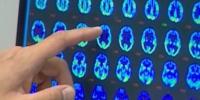 Healthier Hawaii: Warning signs of dementia, tips for healthy aging brains