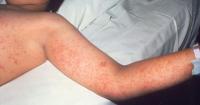 Health Beat: CDC investigates deadly measles outbreak in Pennsylvania