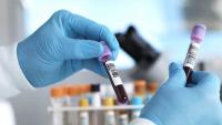 Get the Facts: What to know about multi-cancer tests coming up in the Iowa governor's race