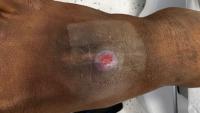 Tauranga doctor identifies foot sore as rare tropical disease yaws