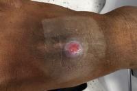Tauranga doctor identifies sore as rare disease