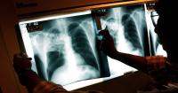 2 active tuberculosis cases traced to San Francisco strip club