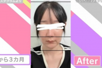 Japanese TV Personality Reports Facial Numbness After Korean Jaw Surgery