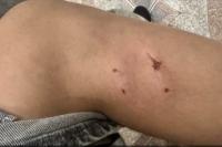 "The owner just left." In Minsk, a child was bitten by a dog, no one helped the girl