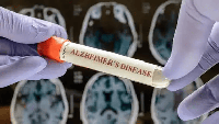 Active Aging: What’s new in Alzheimer’s and dementia research
