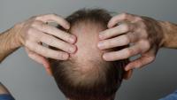 Scientists Tested an Experimental Baldness Pill on 536 Men. Here’s What Happened.