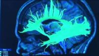 Boston University-led study estimates 75% of former NFL players who died between 2008-2023 had CTE