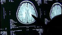 Boston researchers share new, more complete estimate of CTE in ex-NFL players