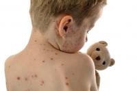 Lakewood Health System Expanding Measles Screening As Cases Still Rise In Central Minnesota
