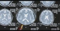 Boston researchers estimate nearly 75% of deceased NFL players from 2008-2023 had CTE