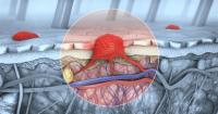 <![CDATA[Cemiplimab Data From EMPOWER-CSCC-1 and C-POST Reshape Advanced CSCC Care]]>