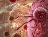Food insecurity tied to higher death risk in cancer survivors